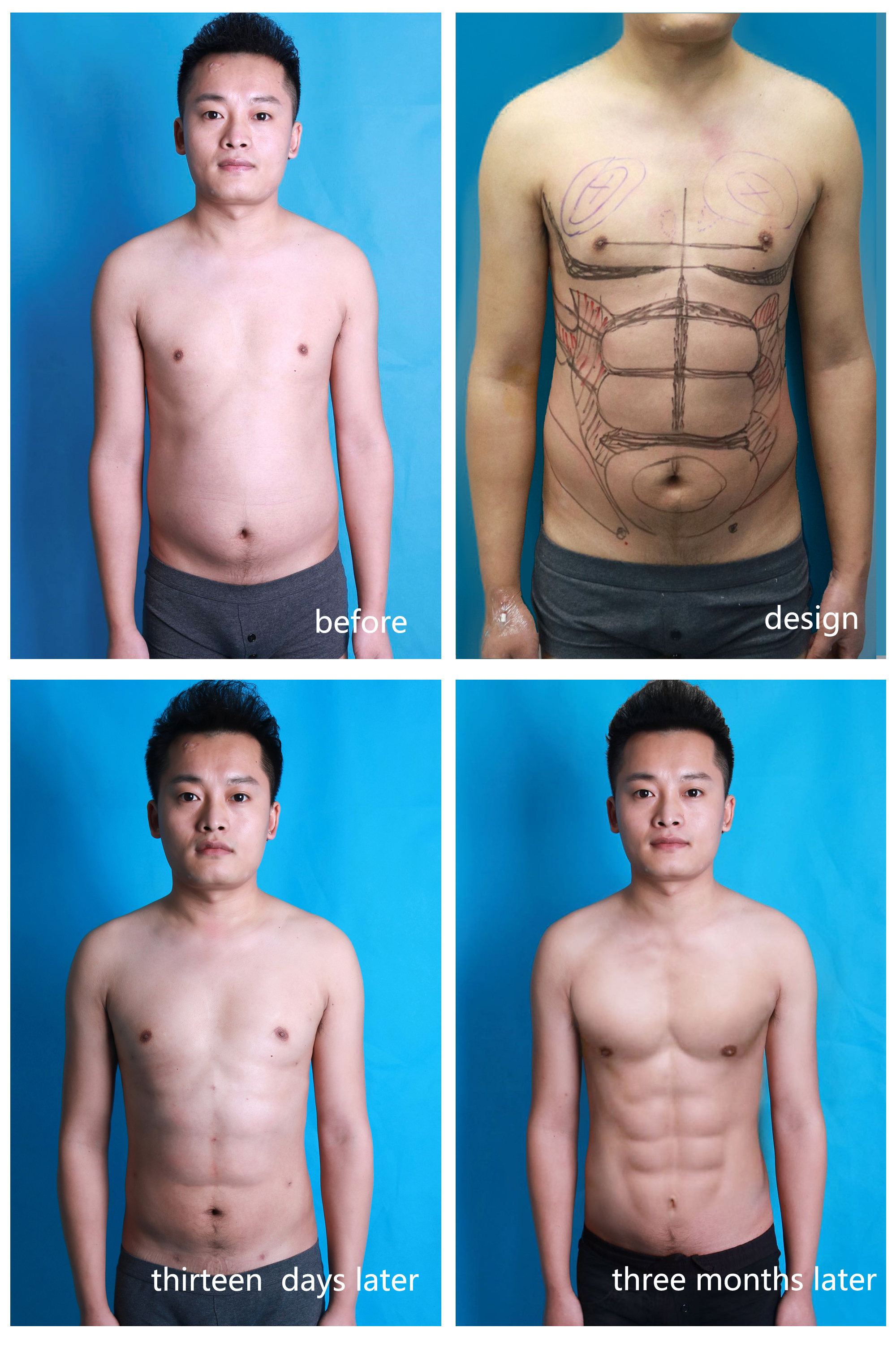 《抽脂》(图1)